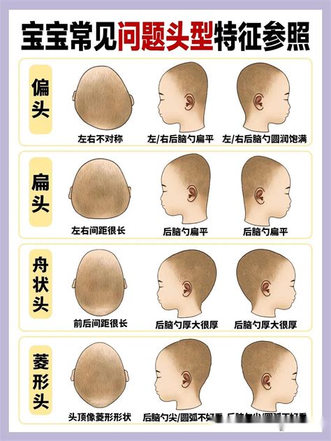 嬰兒額頭突出|頭型異常